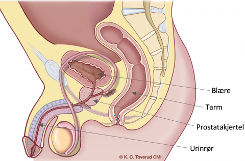 Tversnitt av et mannlig underliv som viser med piler hvor blære, tarm, blære, prostatakjertel og urinrør er plassert