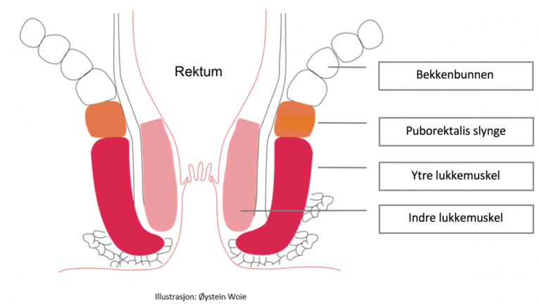 Illustrasjon fra fremsiden av et bekken, som viser med streker plassering av rektum, bekkenbunn, puborektalis slynge, samt ytre og indre lukkemuskel