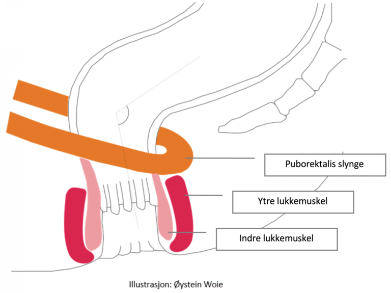 Illustrasjon fra siden av et bekken, som viser med streker plassering av puborektalis slynge, samt ytre og indre lukkemuskel